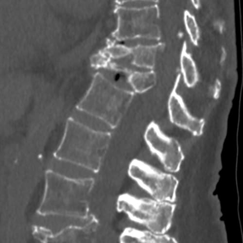 https://www.rachis.paris/wp-content/uploads/2019/04/fracture-vertebrale-osteoporotique-fracture-colonne-vertebrale-consequences-fracture-vertebre-temps-de-guerison-espace-francilien-du-rachis-clinique-du-rachis-versailles-paris-1.jpeg