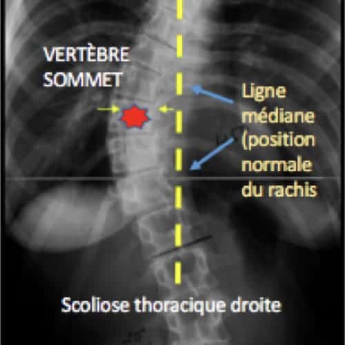 Scoliose de l'adulte que faire ? Espace Francilien du Rachis — free download