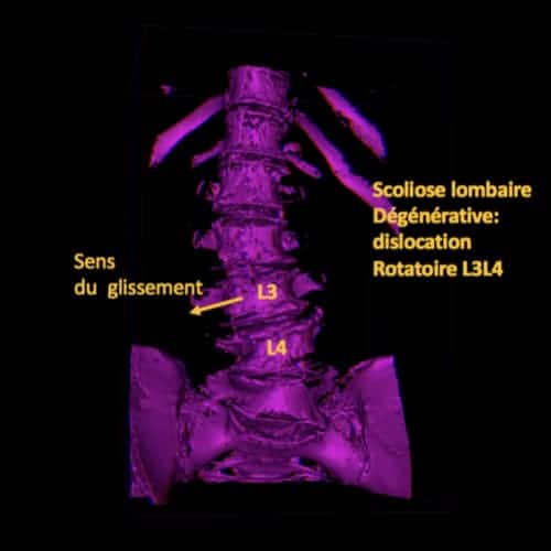 Scoliose de l'adulte que faire ? Espace Francilien du Rachis — free download