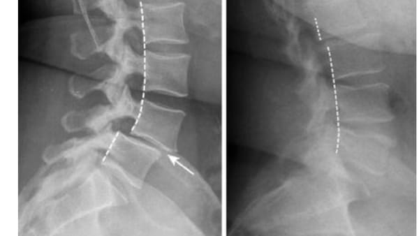 spondylolisthesis lombaire definition spondylolisthesis traitement spondylolisthesis grade 1 spondylolisthesis operation espace francilien du rachis clinique du rachis versailles paris 1