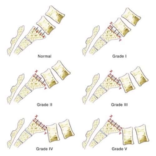 spondylolisthesis par lyse isthmique bilaterale spondylolisthesis